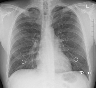 Lungene (pulmones)